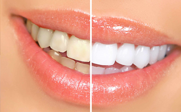 Teeth Whitening